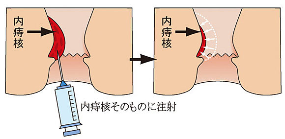 内痔核そのものに注射