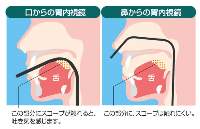鼻から入れる胃カメラで吐き気や苦痛を軽減