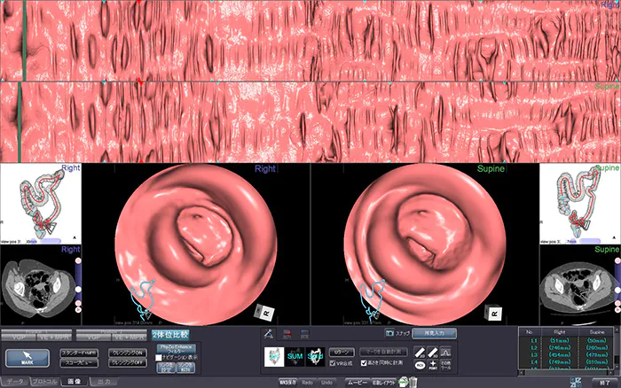 カメラを使わない大腸3D-CT検査とは