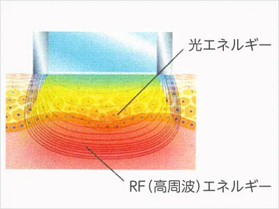 シミ・そばかす・くすみを改善する『SR（フォトRF）』