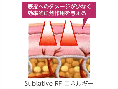ニキビ痕・毛穴の開き・脂質の改善に『サブレイティブ RF』