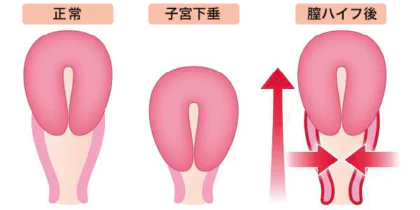 尿漏れ・頻尿の改善