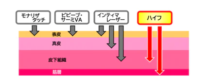 ヨニハイフリニア    （YONI HIFU LINEAR）と    他の施術比較