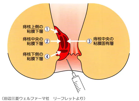 ジオン注射